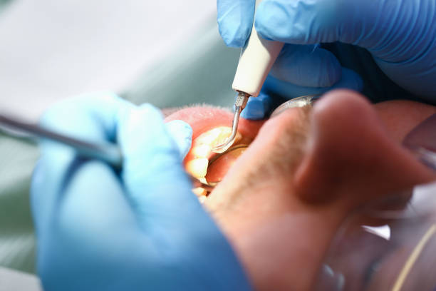 Best Emergency Root Canal Treatment in Cottageville, SC